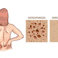 Ból pleców u kobiety z osteoporozą. Porównanie struktury kości: osteoporoza vs zdrowa kość. Czy osteoporoza to rak kości?