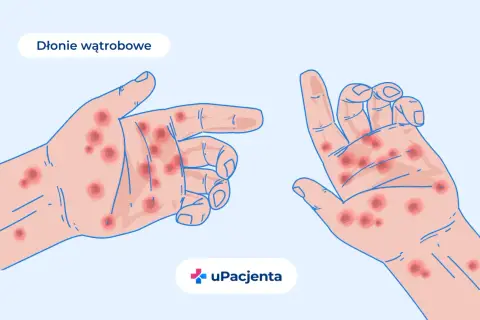 Dłonie z czerwonymi plamkami, ilustracja medyczna.